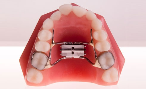 Application of the elastics from the screws to the mandibular teeth.